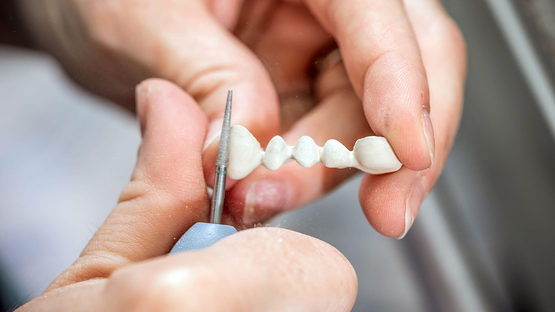 Reparatur von gebrochenen Zähnen