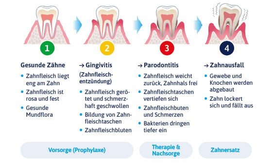 Stadien der Zahnfleischentzündung und Parodontitis